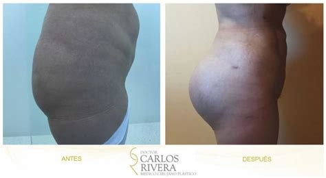 Galería de fotos Gluteoplastia Dr. Carlos Rivera | True Doctors