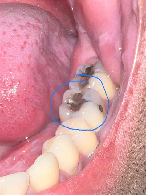 Tooth feels weird after dental visit : r/askdentists