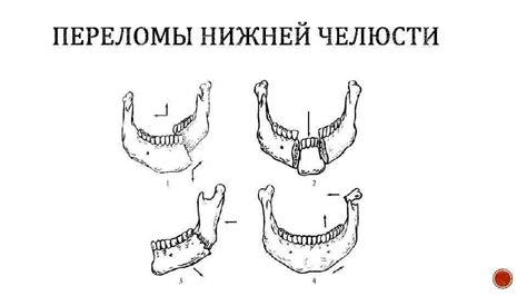 КЛАССИФИКАЦИЯ ПЕРЕЛОМОВ ВЕРХНЕЙ И НИЖНЕЙ ЧЕЛЮСТИ В