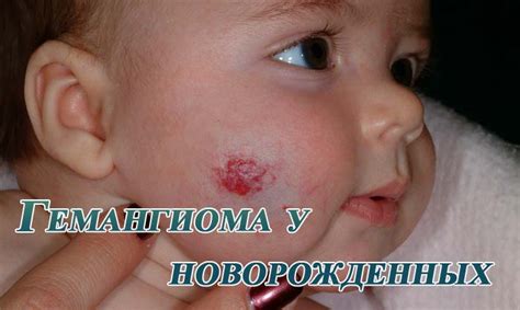 Что такое гемангиома у детей фото