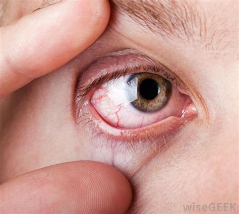 What Is Xerophthalmia? (with pictures)Dry eye Autoimmune Thyroid ...