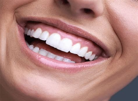 What is a Gingival Smile? - کلینیک پوست، مو و زیبایی ایرسا