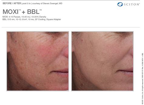 clinic holland park private cosmetic clinic west london bbl
