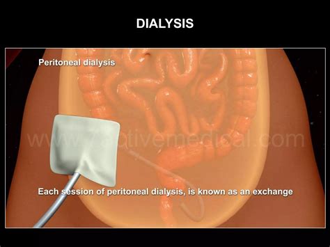 Dialysis | PPTX