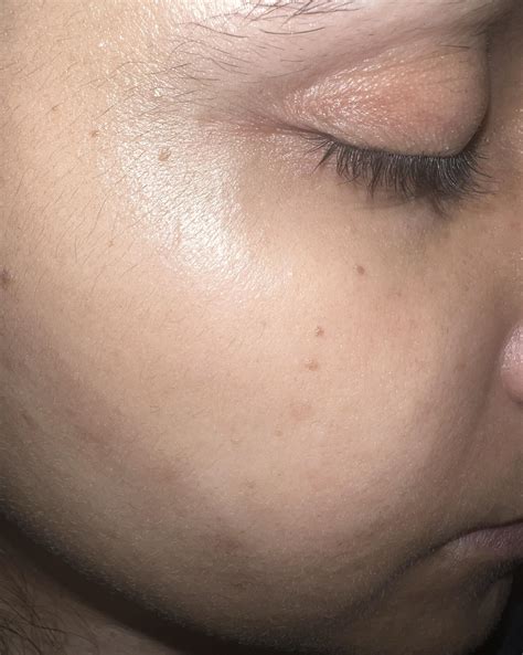 What are these black spots or moles on skin. Got it after pregnancy