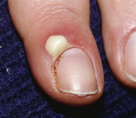 acute toe paronychia