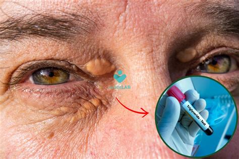 Trigliceridos Altos Sintomas | Trigliceridos Elevados – MGNAR