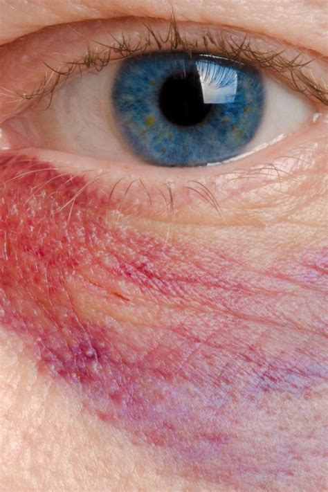 Eye Makeup Allergy