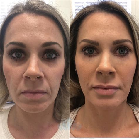Juvederm Cheeks Before And After Photos