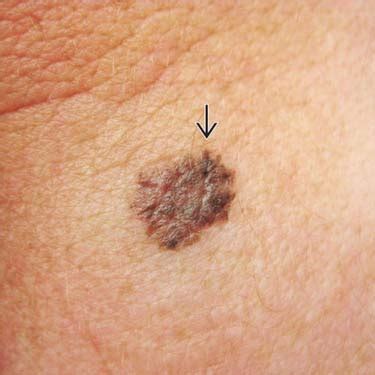 Nodular Melanoma Stages