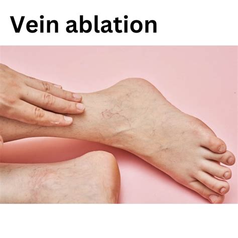 Tips for Speeding up Vein Ablation Recovery