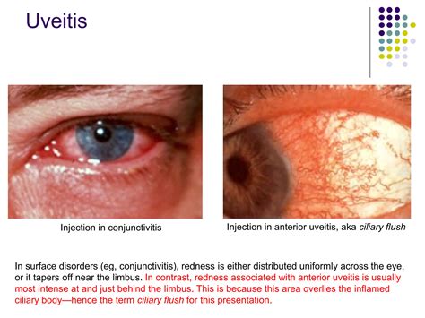 uveitis   eye anterior uvitis  posterior uveitis