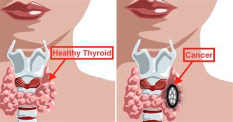 Everything People Need To Know About Thyroid Disorders: Causes ...