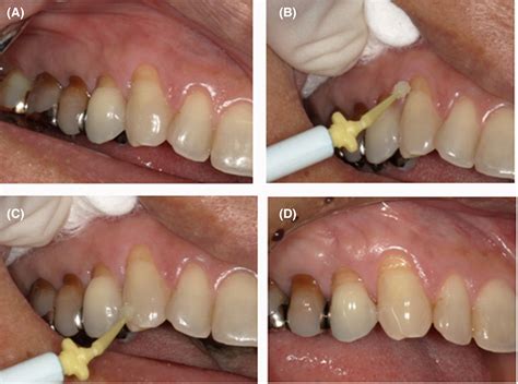 Treatments Of Dental Crown Caries, Root Surface Caries, And, 47% OFF