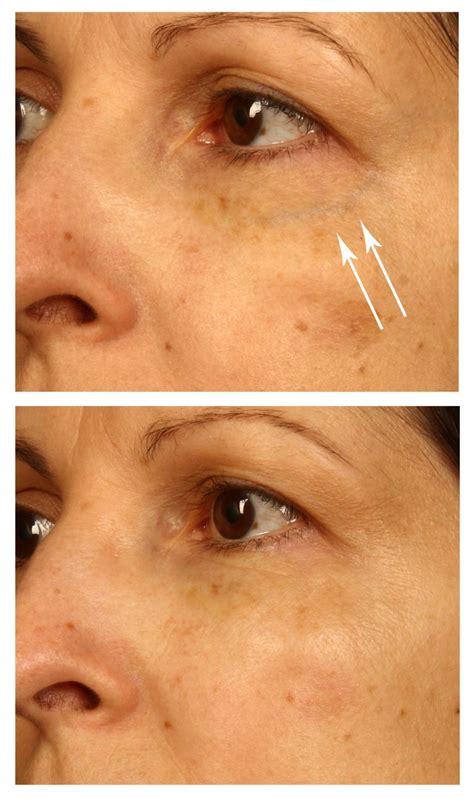 Laser Treatment for Blue Veins Around Your Eyes - The Cosmetic Vein ...