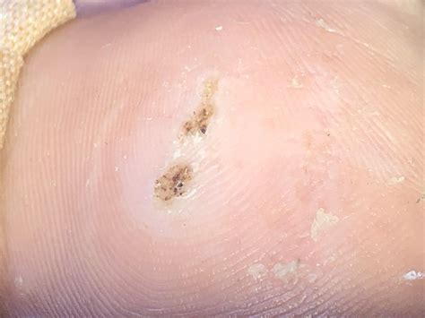 Treating plantar warts with ACV : r/Warts