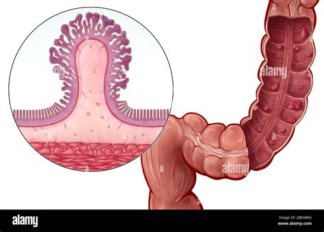 Pedunculated colorectal polyp hi-res stock photography and images - Alamy