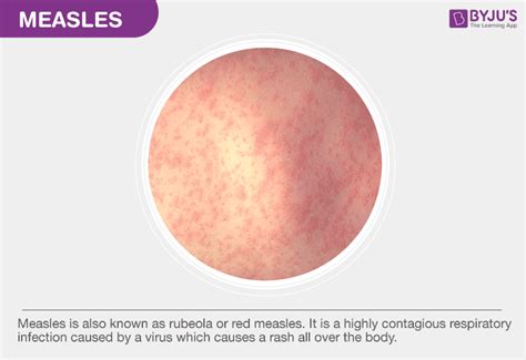 Measles - Causes, Symptoms, Treatment, Prevention