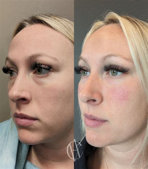 Under Eye Filler in Milwaukee — ⬦ A-Class Aesthetics