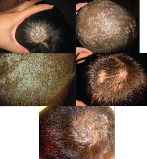 Tinea Capitis Treatment