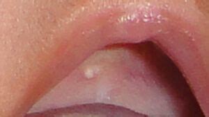 bumps  roof  mouth