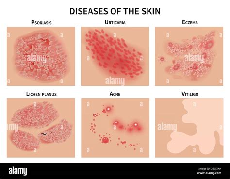 Skin diseases. Derma infection, eczema and psoriasis. Dermatology ...