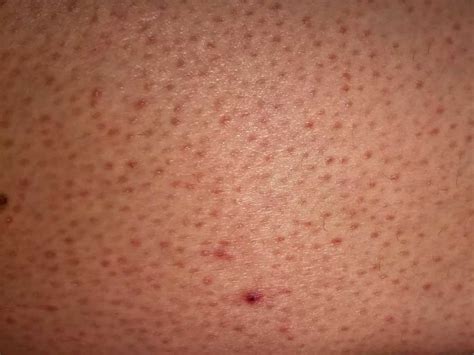 Mild Keratosis
