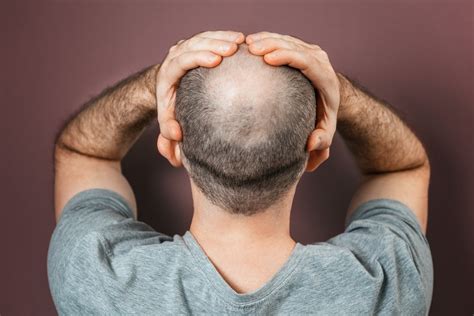 How to Regrow Hair on Bald Spot Fast - Wimpole Clinic