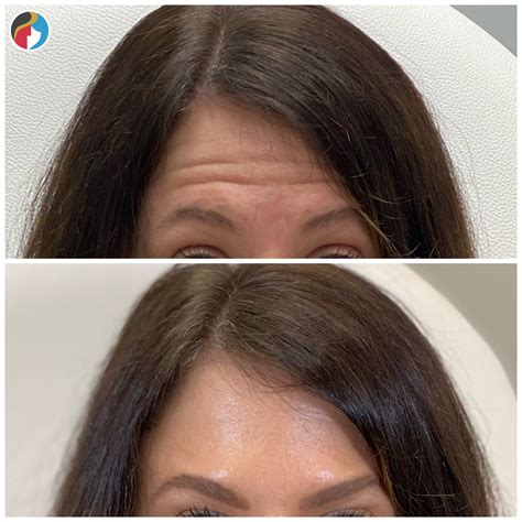 Botox Treatment | Syracuse, Albany, Rochester, New Hartford