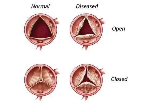 Heart Valve Disease Information | Edwards Lifesciences