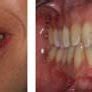 Case 3 (Implant in right maxillary central incisor). | Download Scientific Diagram