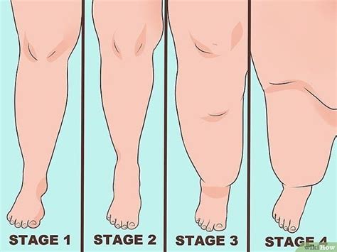 Understand the stages of lipedema. As with many disorders and diseases ...
