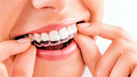 Overbite Correction | Dental Braces | Smile Centre India