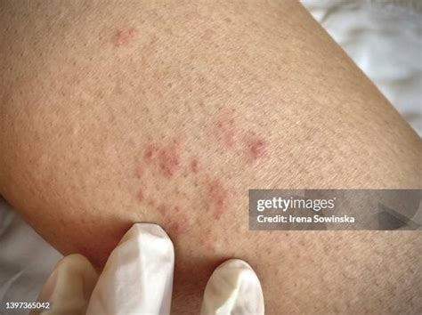 55 Herpes Zoster Rash Stock Photos, High-Res Pictures, and Images ...