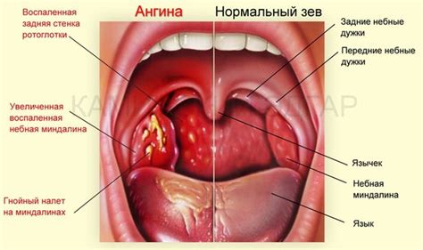 Ангина: обычная и опасная ~ Fitness | SportLife