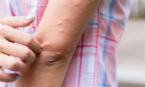 Alergia A Uva Roxa Sintomas