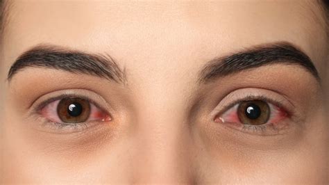 Red Eyes And Weed: Explaining The Phenomenon