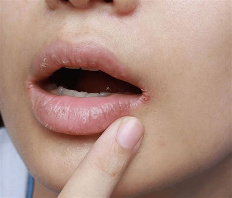 What You Need To Know About Angular Cheilitis