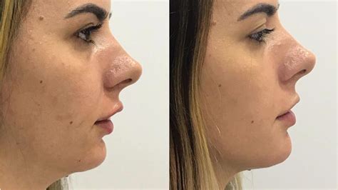 Lipo De Papada Antes E Depois - Lipo de Papada: conheça os benefícios e resultados incríveis