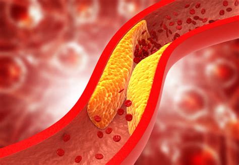clogged arteries stock  pictures royalty  images istock