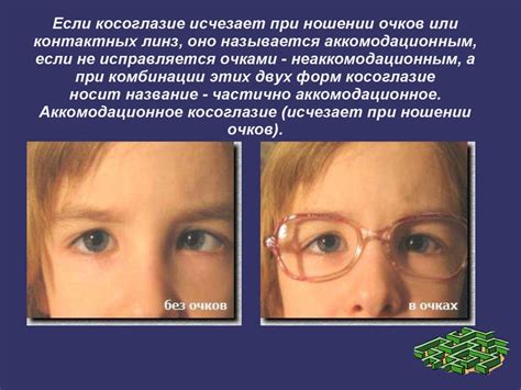 Косоглазие. Причины, виды - презентация онлайн