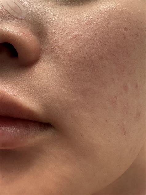 What are these bumps near my nose : r/SkincareAddicts