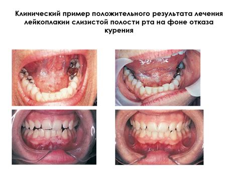Рак слизистой оболочки полости рта и красной каймы нижней губы ...
