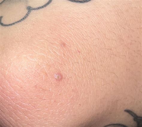 small bump on outer elbow : r/DermatologyQuestions