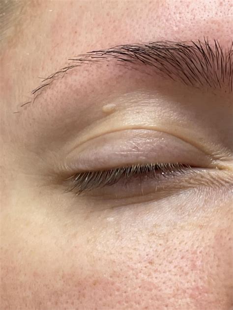 What is this bump on my eyelid? I’ve had it for years and I don’t think ...
