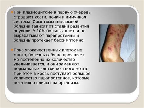 Миеломная болезнь (плазмоцитома) Что такое плазмоциты?
