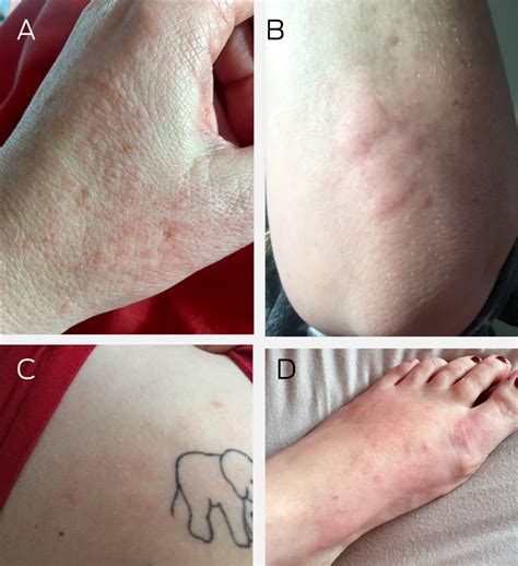 Cutaneous manifestations of COVID‐19: diagnosis and management | The ...