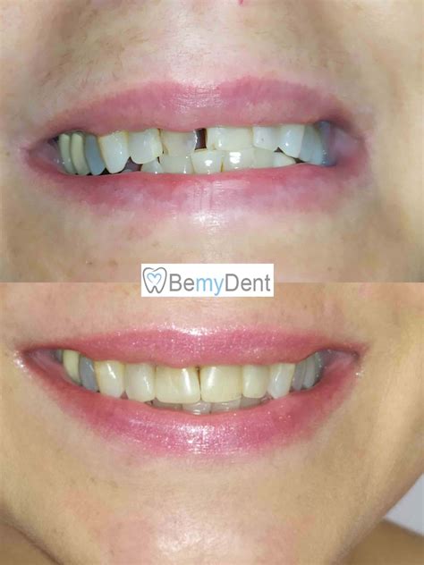 Композитни фасети - бондинг | Дентално Студио BemyDent | София