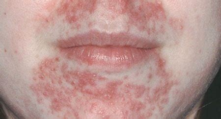 Perioral Dermatitis - Dermatologist in Massapequa, NY | Massapequa ...