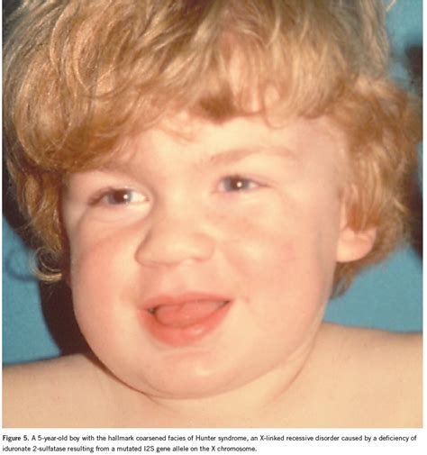 Hunter Syndrome (Mucopolysaccharidosis II): Diagnosis, Genetic Testing, Treatment, and Referral ...